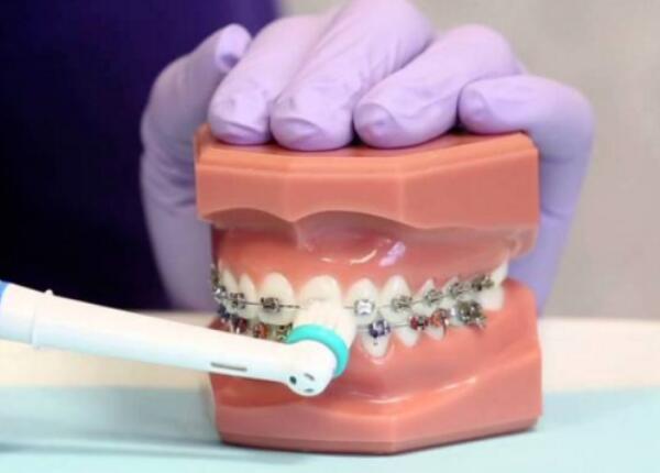 戴了牙套怎么使用電動(dòng)牙刷？正確使用牙刷很重要