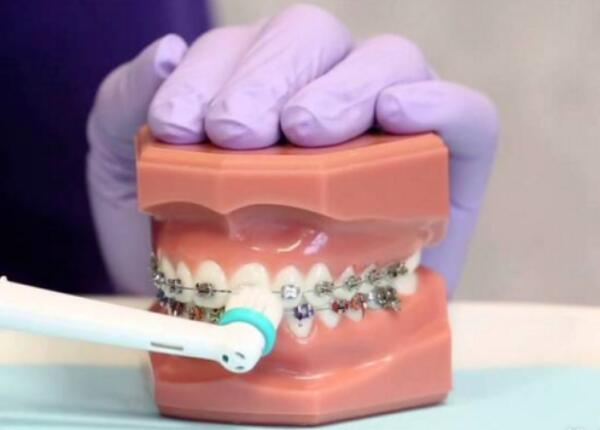 卸了牙套能用電動牙刷嗎？答案就在這篇文章